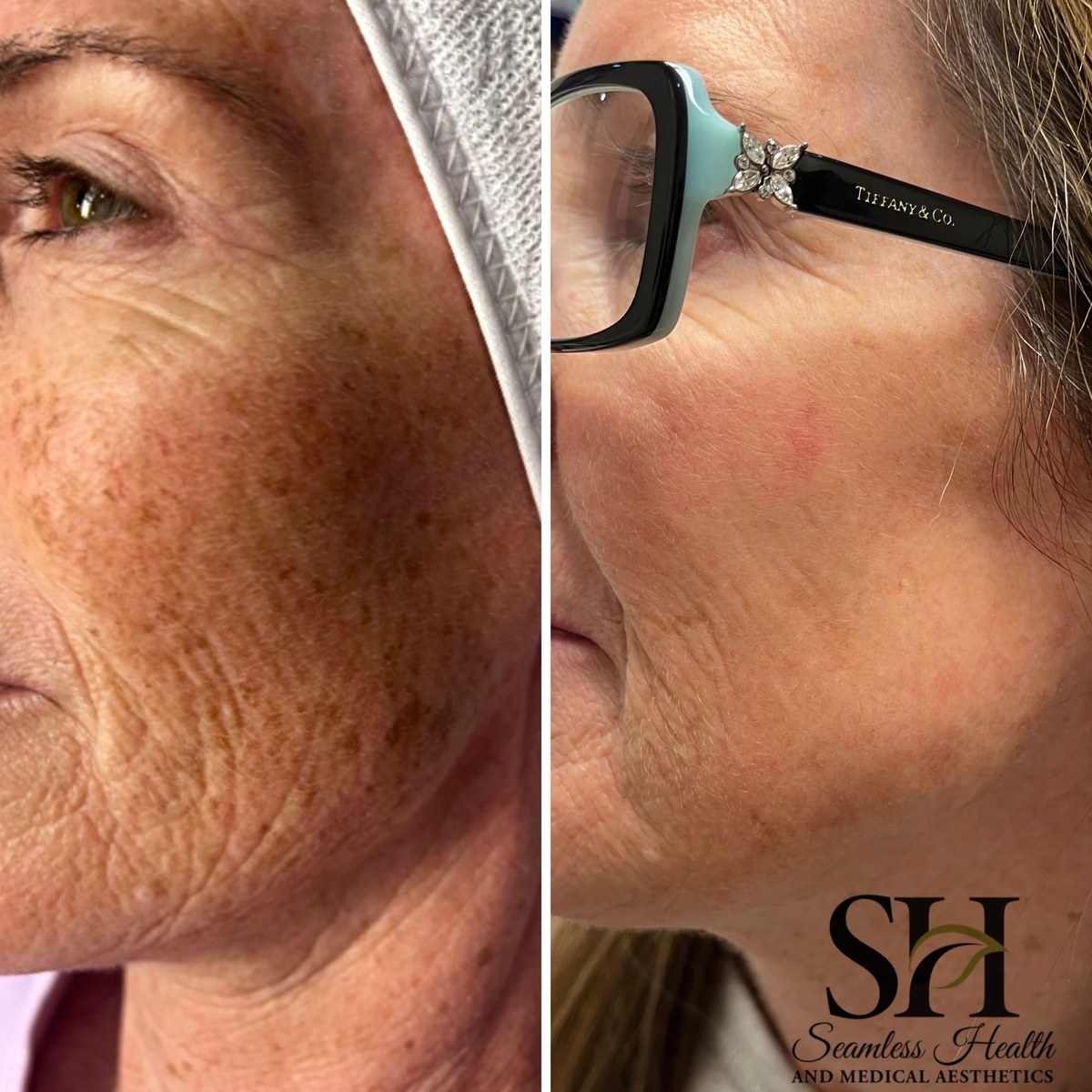 IPL before and after: brown sun spots on the cheek visibly cleared