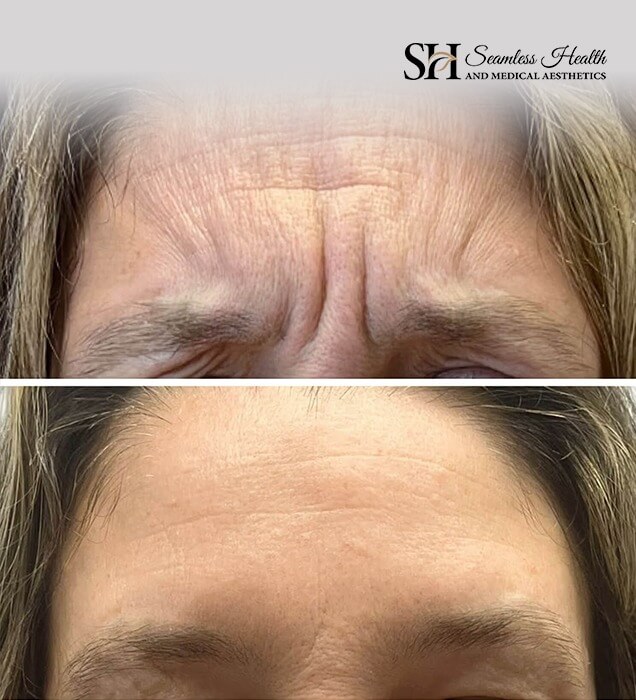 Before and after photographs of horizontal forehead lines, deeply etched above and smooth below