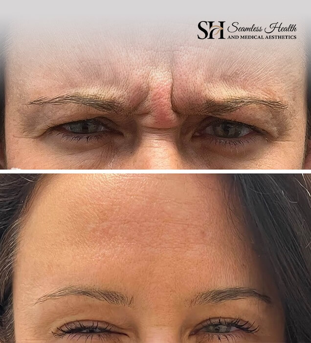 Before and after photographs of frown lines between the eyebrows