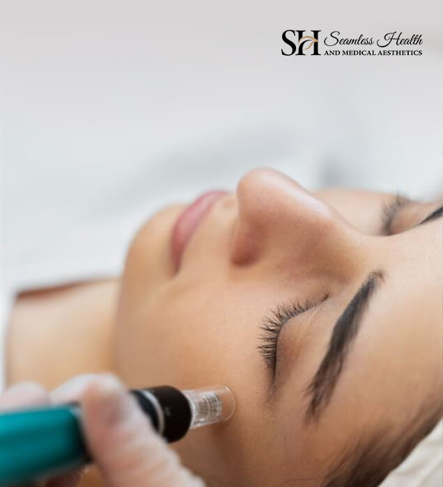 Close-up of microneedling treatment on a patient's cheek