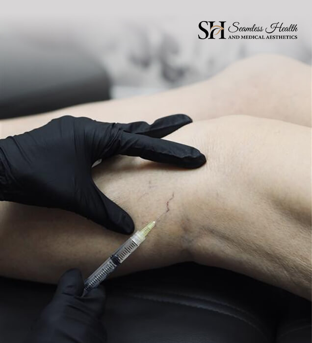 Sclerotherapy injection into a leg vein