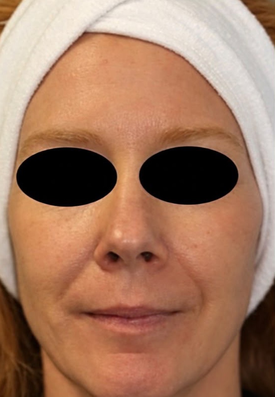 The same Seamless Health patient after CO2 skin resurfacing, with smoother, more even skin