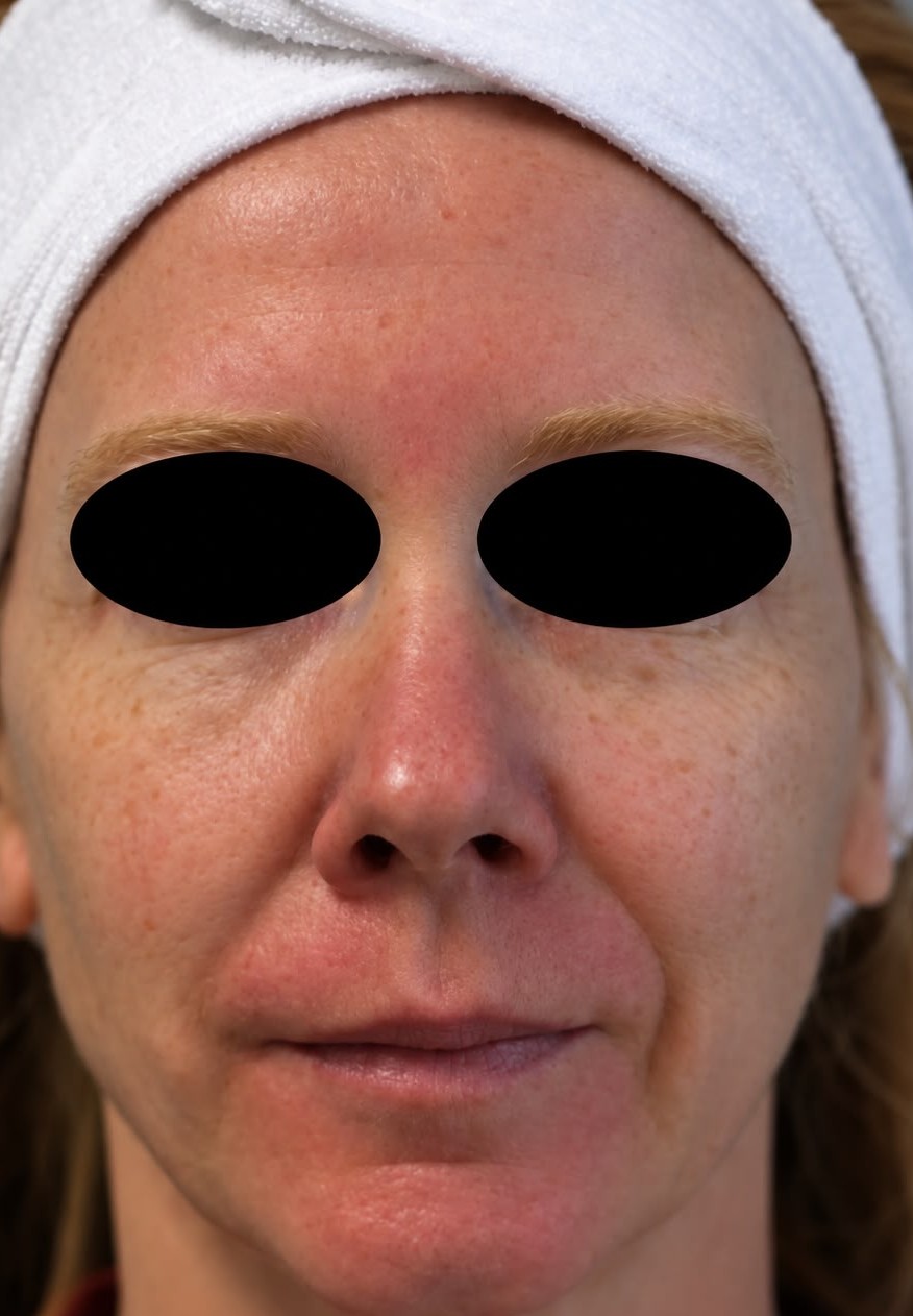 Seamless Health patient before CO2 skin resurfacing