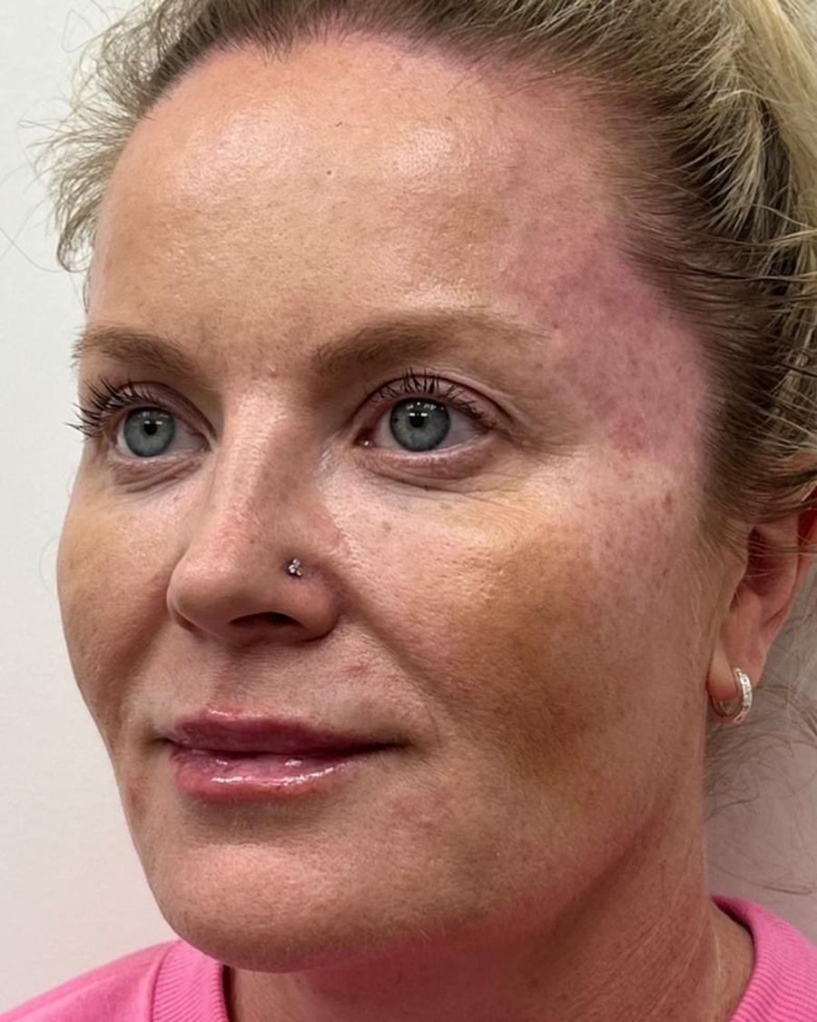 Seamless Health patient after dermal filler treatment showing restored lip and cheek volume