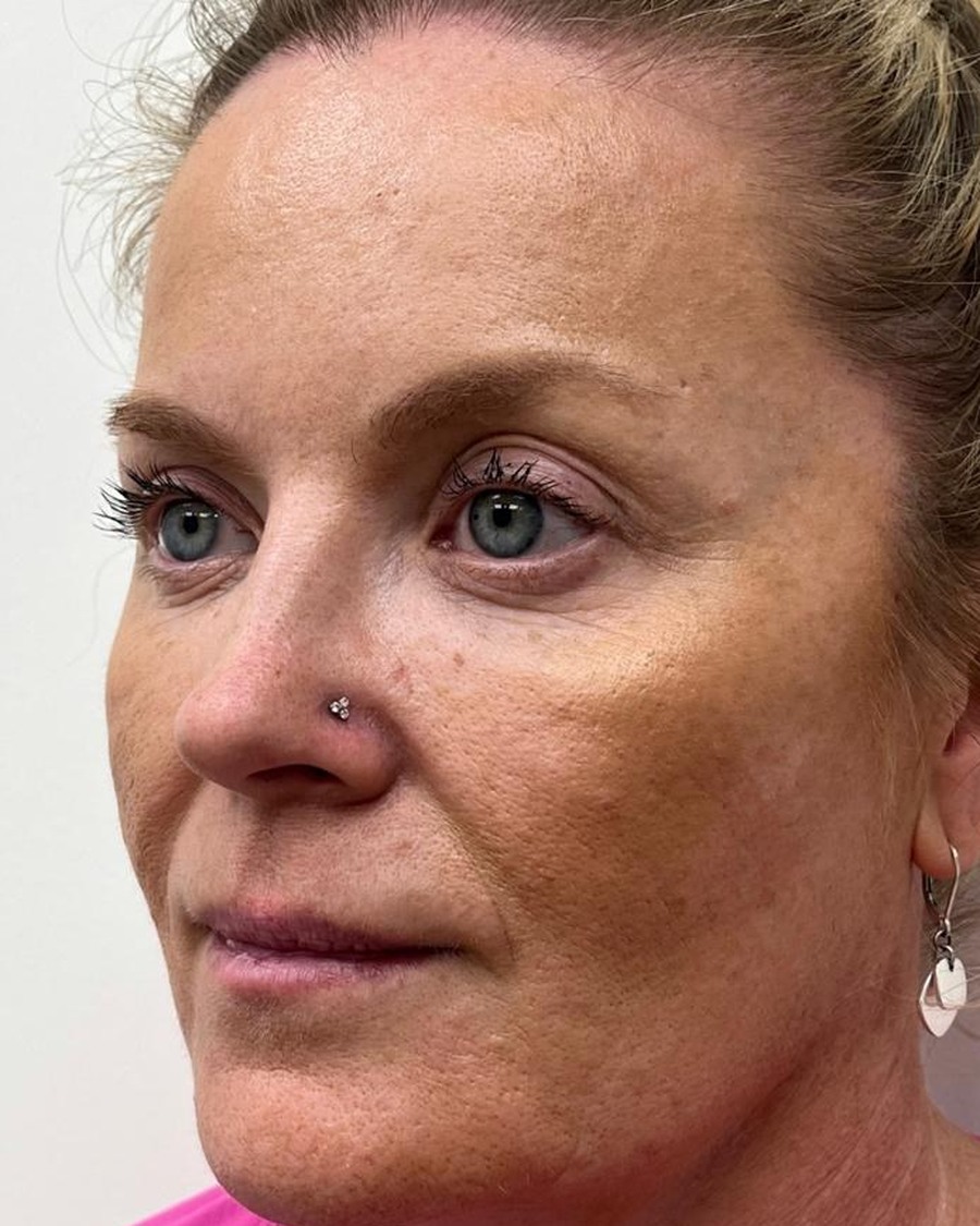 Seamless Health patient before dermal filler treatment