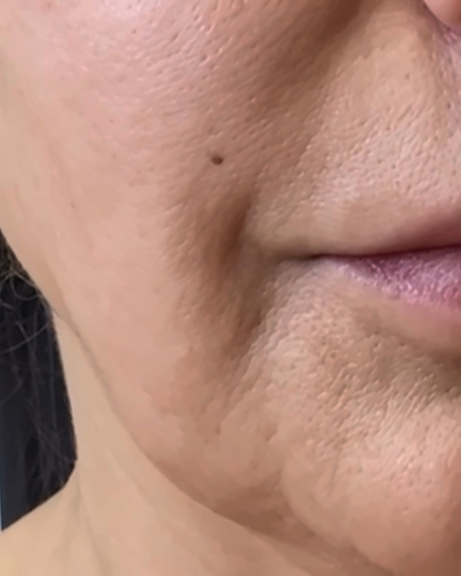 Seamless Health patient before fat dissolving treatment, showing submental fullness and a softened jawline
