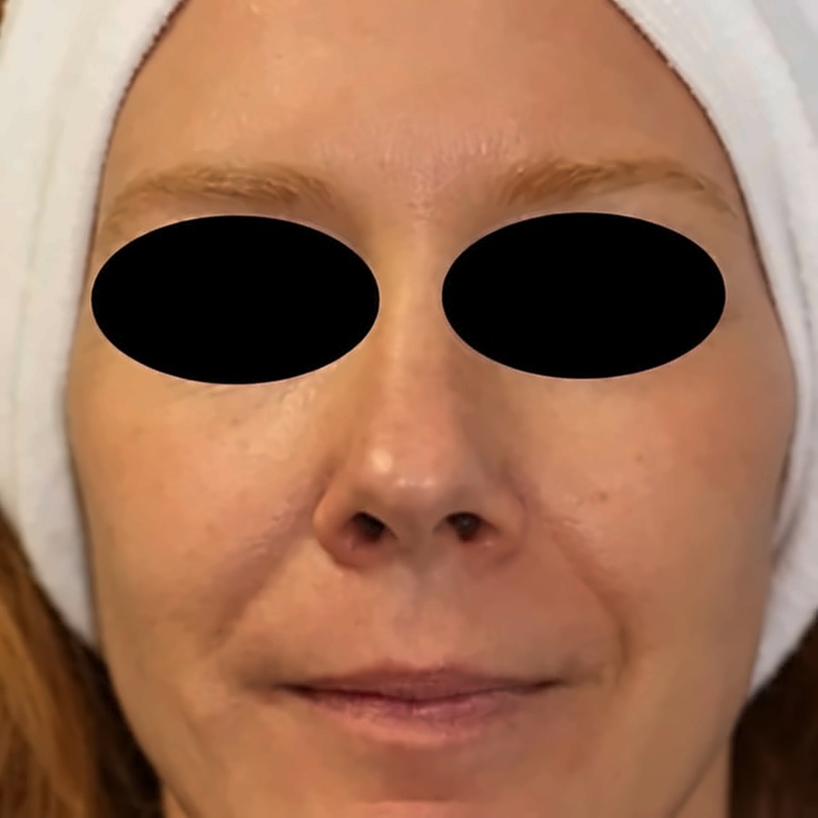 Seamless Health patient after IPL photofacial, showing calmer and more even skin tone