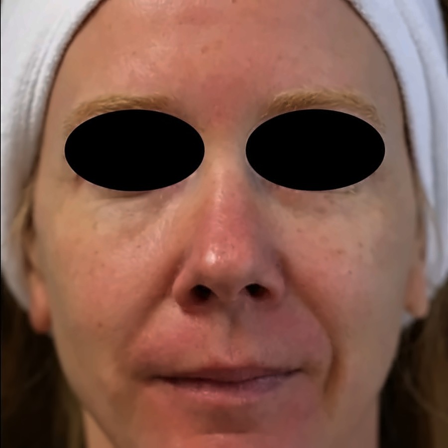 Seamless Health patient before IPL photofacial, showing diffuse facial redness