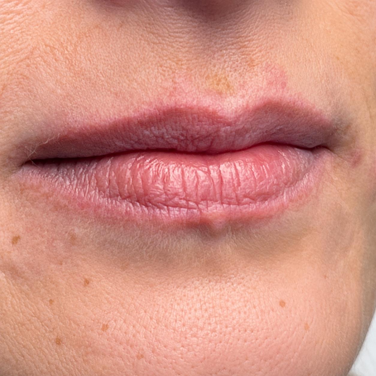 Seamless Health patient before lip filler treatment