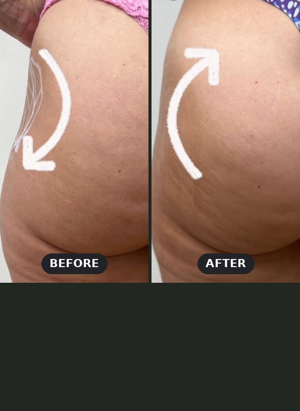 Non-surgical butt lift before and after at Seamless Health