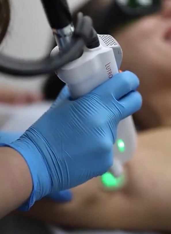 Laser hair removal on the underarm at Seamless Health