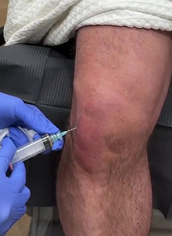 PRP injection into the knee for joint pain at Seamless Health