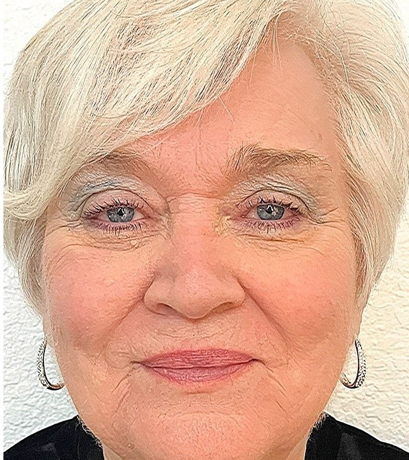 A Seamless Health Ultherapy patient before and after treatment, showing a firmer jawline and neck