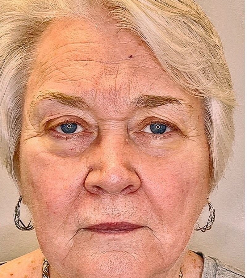 A Seamless Health Ultherapy patient before and after treatment, showing a firmer jawline and neck