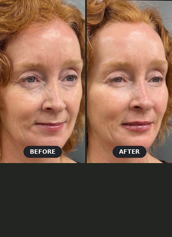 Dermal filler before and after at Seamless Health