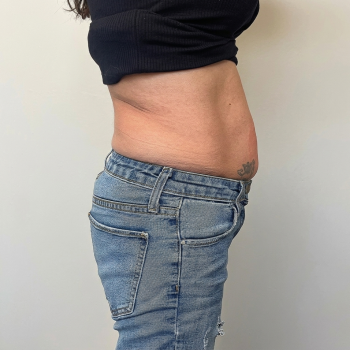 bodycontouring_after_1