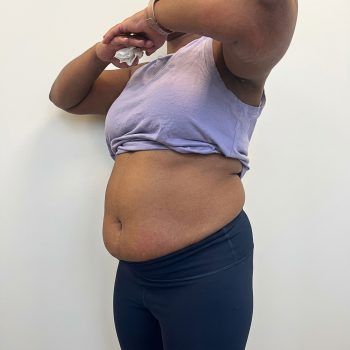 bodycontouring_after_2