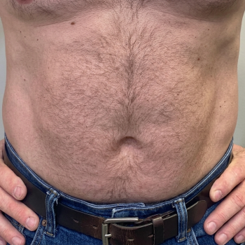 bodycontouring_after_3