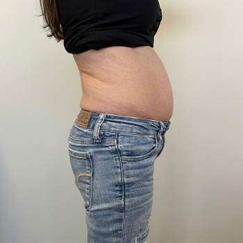 bodycontouring_before_1