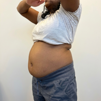 bodycontouring_before_2
