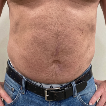 bodycontouring_before_3