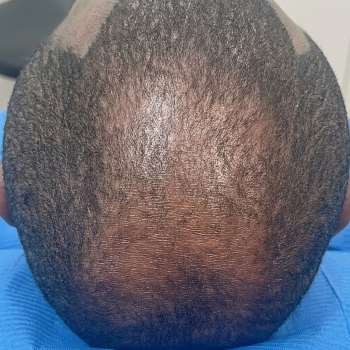 hairloss_after_1