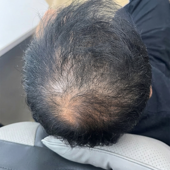 hairloss_after_2