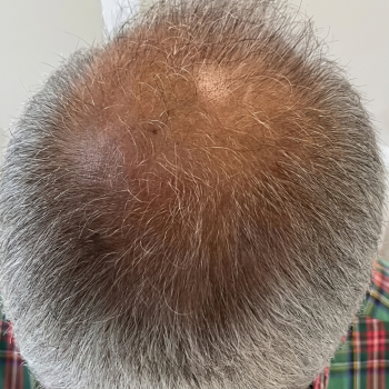 hairloss_after_3