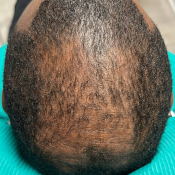 hairloss_before_1