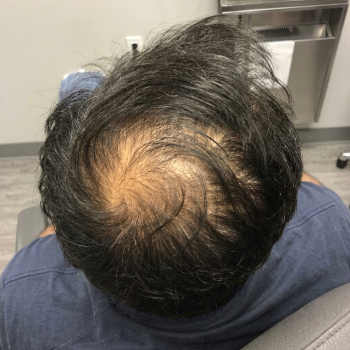 hairloss_before_2