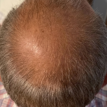 hairloss_before_3