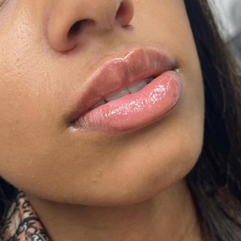 lips_after_1