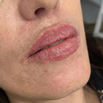 lips_after_2