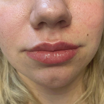 lips_after_3