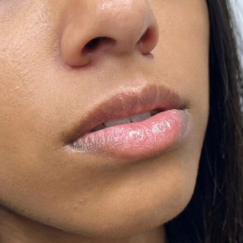 lips_before_1