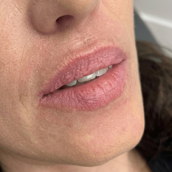 lips_before_2