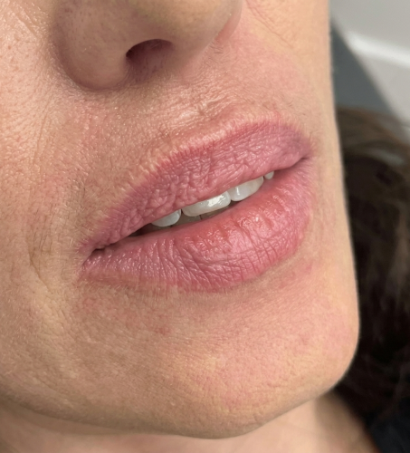 lips_before_2