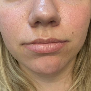 lips_before_3