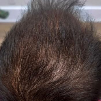 The same patient after PRP hair restoration, with visibly thicker, denser hair on top
