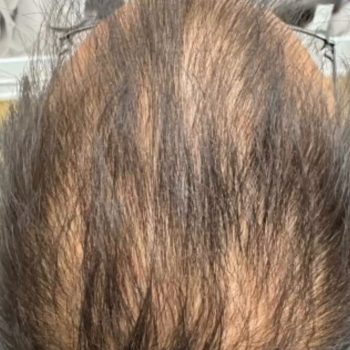 Seamless Health patient scalp before PRP hair restoration, showing thinning on top