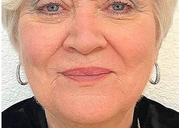 ultherapy-after