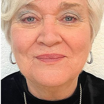 ultherapy-after