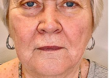ultherapy-before