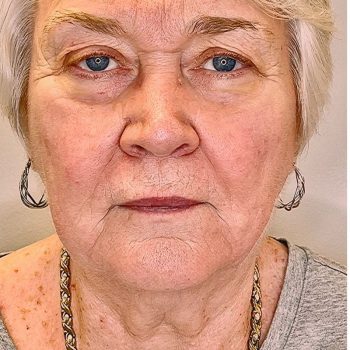 ultherapy-before
